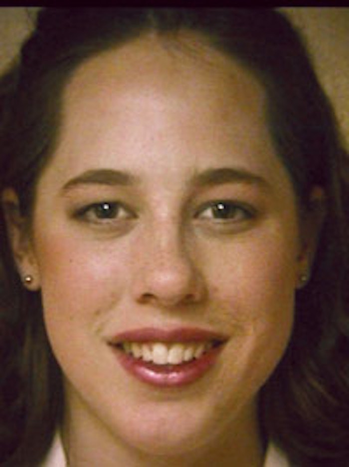 The second-degree burn on the left side of the face is no longer visible after an application of camouflage makeup.