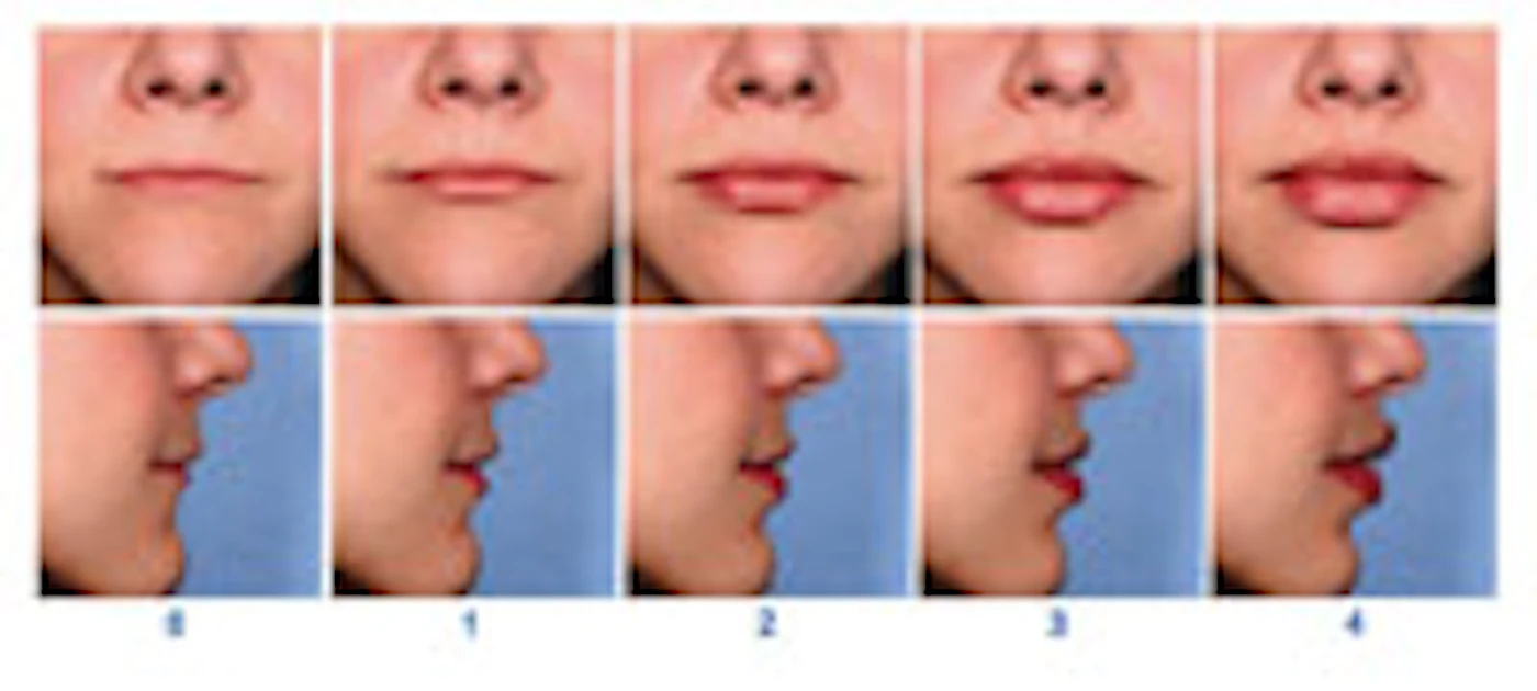Merz Injection Pattern Merz Pharmaceuticals Merz Scales | Skin Inc.
