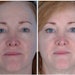These images show a before and after of fractionated CO2 treatment for skin rejuvenation on the face. The patient also used a topical product following the procedure for moisturization and sun protection.