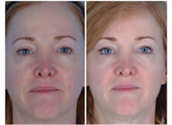 These images show a before and after of fractionated CO2 treatment for skin rejuvenation on the face. The patient also used a topical product following the procedure for moisturization and sun protection.