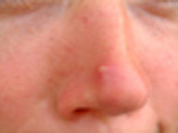 Acne_nose