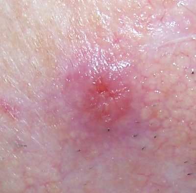 SI1101-Linder_squamouscell