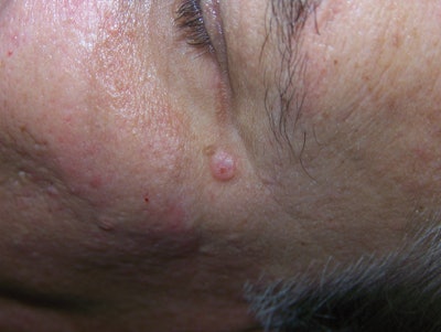 SI1102-Linder_basalcellcarc