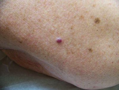 SI1102-Linder_cherryhemangi