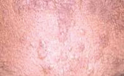 SI1102-Linder_verucaplanae