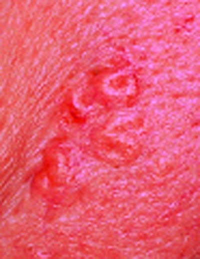 SI1102 Linder_sebaceoushyper