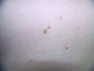 SI1102 Linder_seborrheic