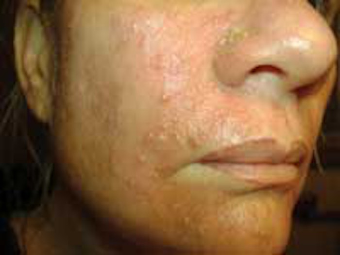 This is a pustular reaction to an aggressive superficial peel of 30% salicylic acid after microdermabrasion.