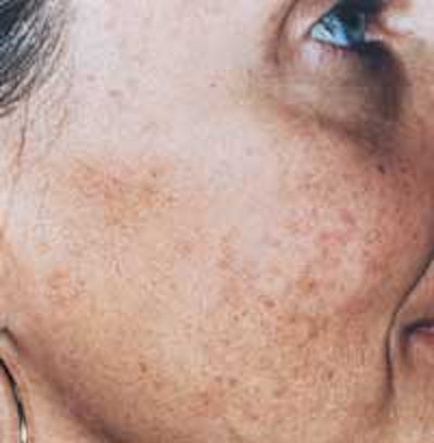 SI1103-Wild_hyperpigmentati