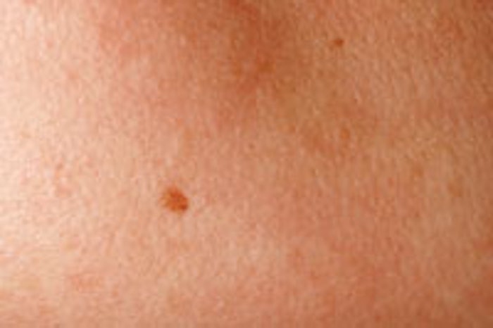 Inlay Mole