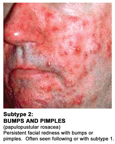 New-Subtype-2-2010-with-cap