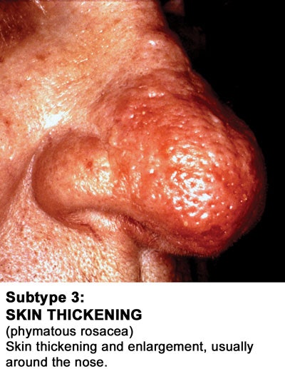 New-Subtype-3-2010-with-cap