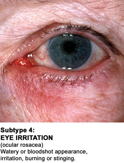 New-Subtype-4-2010-with-cap