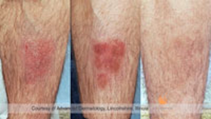 Stages of psoriasis