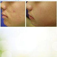 A Multifaceted Approach to Acne  Skin Inc.
