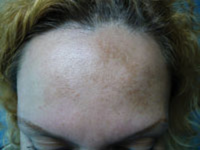Because melasma is a chronic condition with high rates of recurrence, clients who are predisposed to developing melasma may find current treatment modalities needlessly frustrating and difficult.