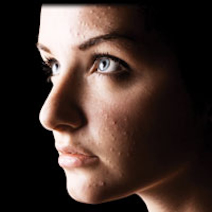 Acne Lady
