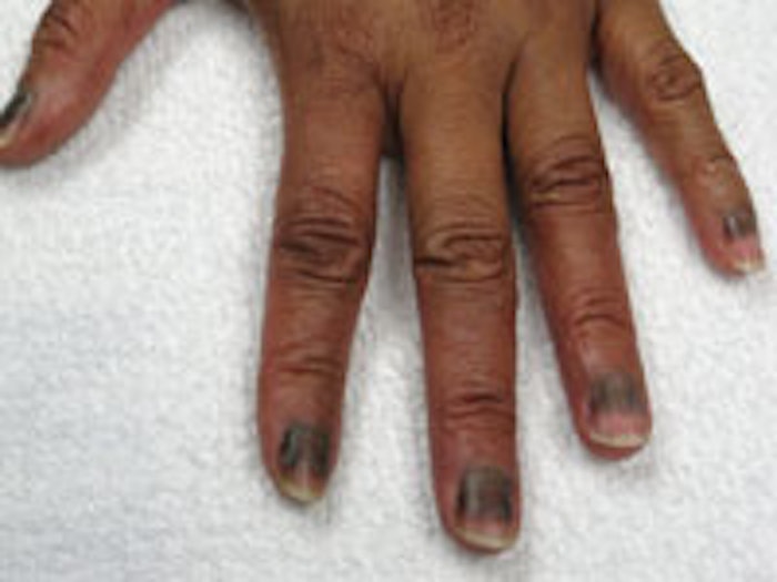 Ingrown nails, nail shedding and dark lines through the nails may occur during cancer treatment.