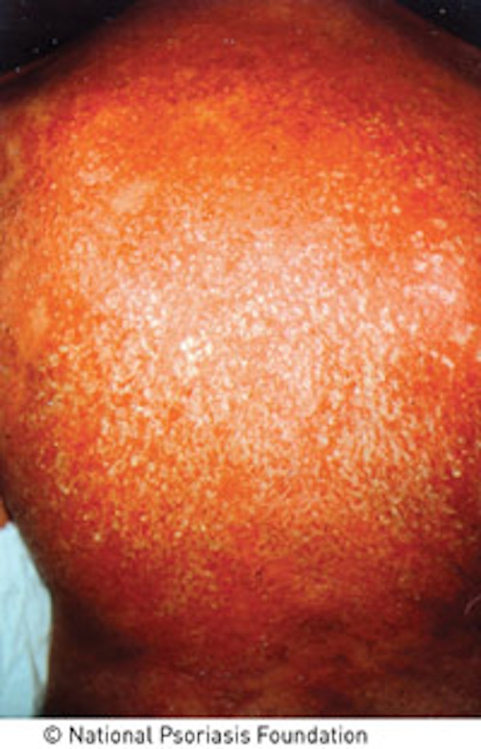 Erythrodermic psoriasis is a particularly inflammatory form of psoriasis that affects most of the body surface.