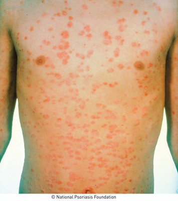 Guttate lesions, which commonly start in childhood or young adulthood, usually appear on the trunk and limbs, and the spots are not normally as thick as plaque lesions.