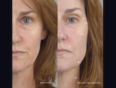 Luminious Eye Therapy