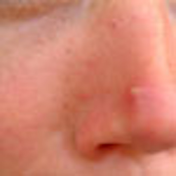 rosacea