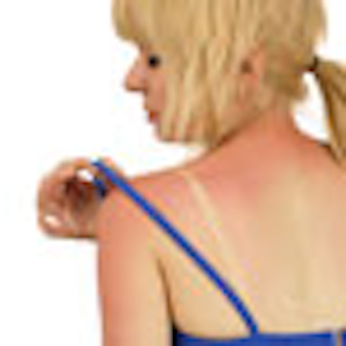 sunburn