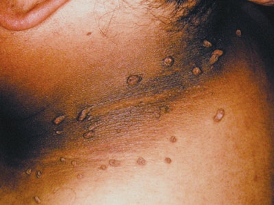 DSCN6099-acanthosis-nigrica_f