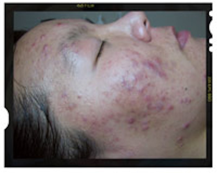 It took four months to clear this client’s inflammed acne and pigmentation, using a combination of mandelic serum, vitamin A proprionate serum and benzoyl peroxide.