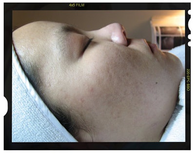 inflammationafter_frame_f