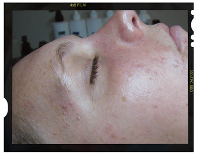 noninflammationbefore_frame_f