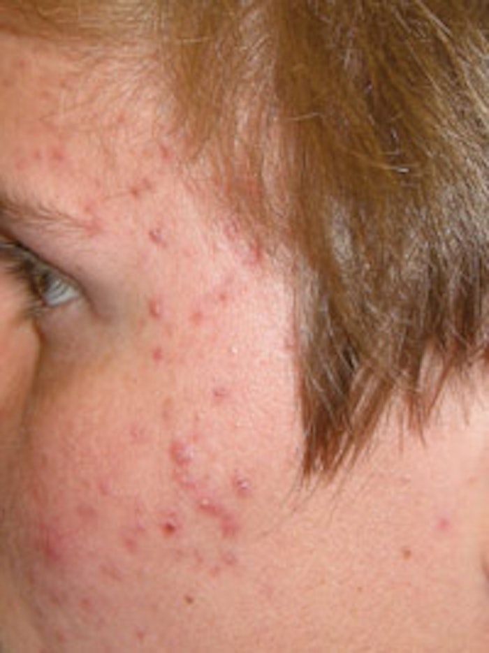 The 3 Stages of Hormonal Skin Care | Skin Inc. The 3 Stages of Hormonal Skin Care | Skin Inc.