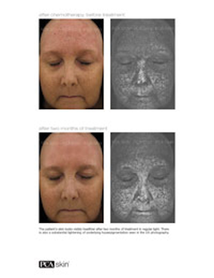 The patient's skin looks visibly healthier in regular light after two months of a chemotherapy and radiation therapy support treatment. There is also a substantial lightening of underlying hyperpigmentation seen in the UV photography.