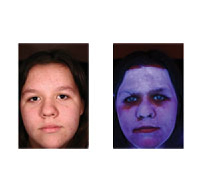Before: After weeks of cleansing with a waxy cleanser, there is no visible occlusion. After: Under UV light imaging, a heavy occlusive layer is visible.