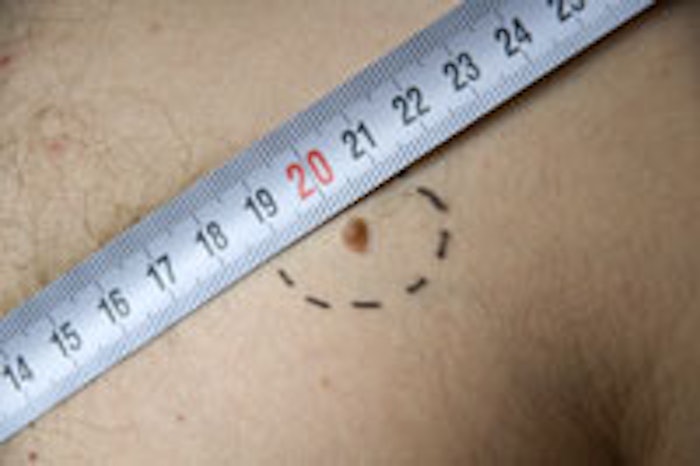 melanoma2_main