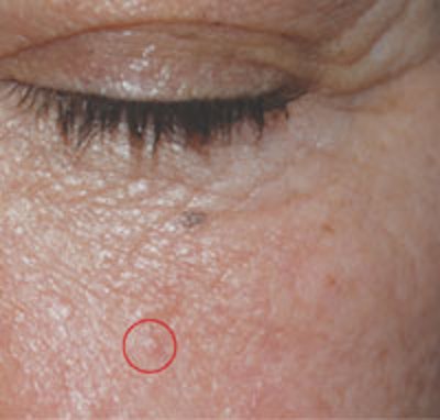 Sebaceous hyperplasia papules are small yellow bumps with a central visible pore.