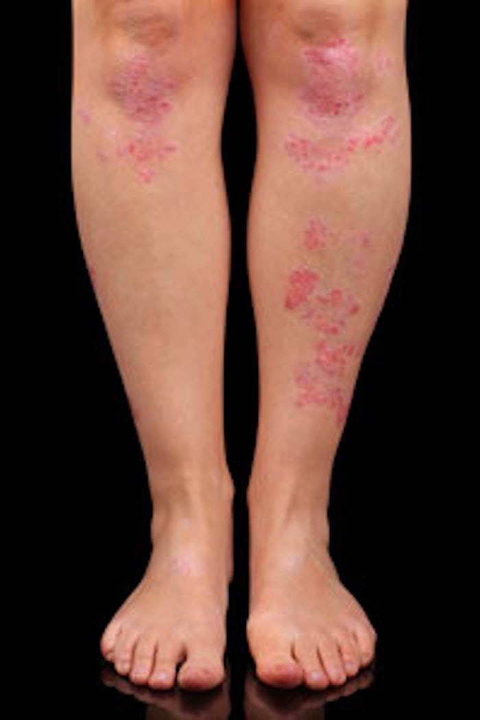 psoriasis_m1