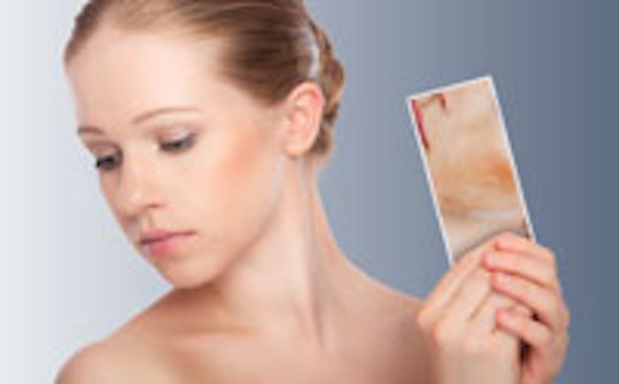 rosacea_m2