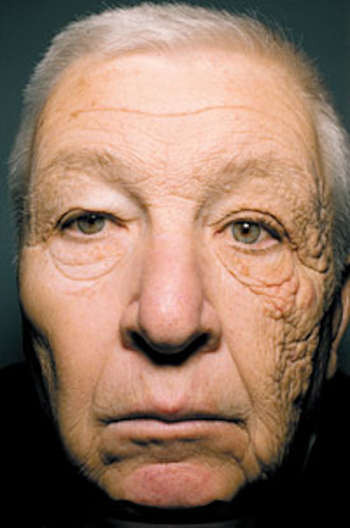 A 69-year-old man, who reported driving a delivery truck for 28 years, with a 25-year history of gradual sun damage on the left side of his face. Photo courtesy of The New England Journal of Medicine (2012)