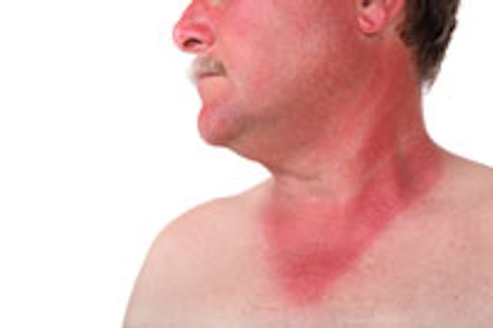 sunburn_m1