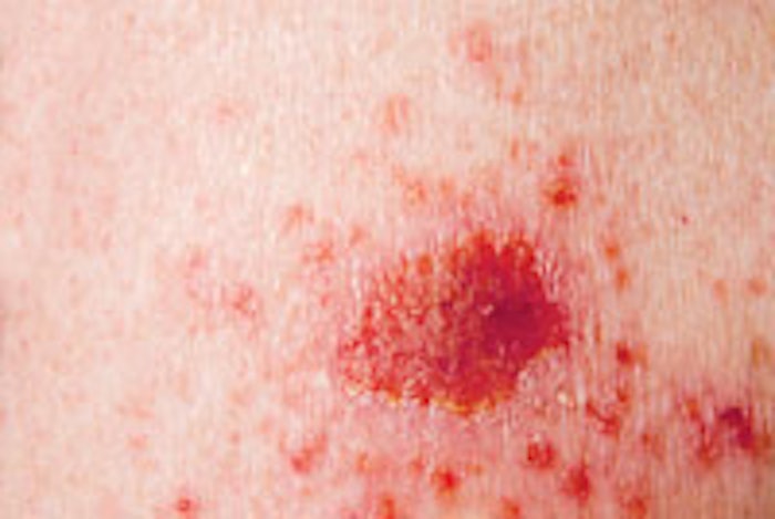 Basal cell carcinoma