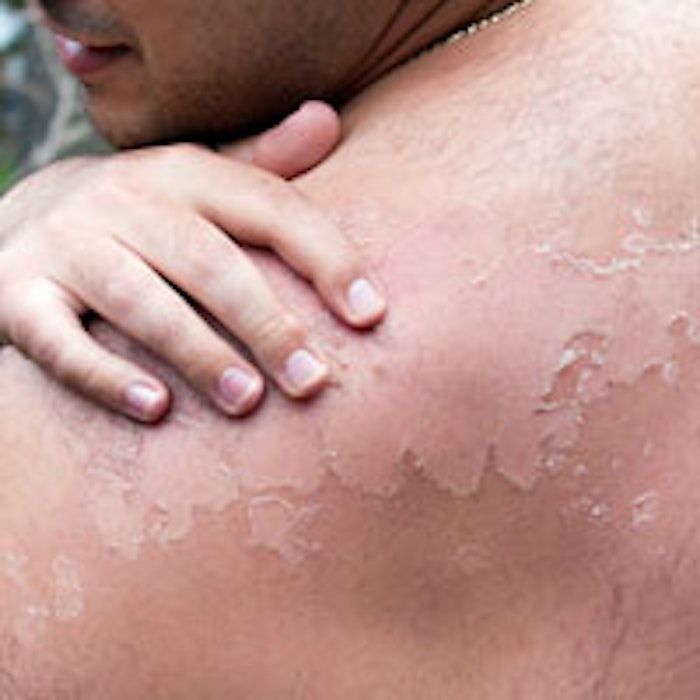 peeling_m