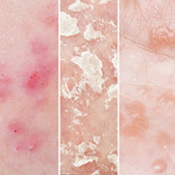 Acne, psoriasis vulgaris and eczema