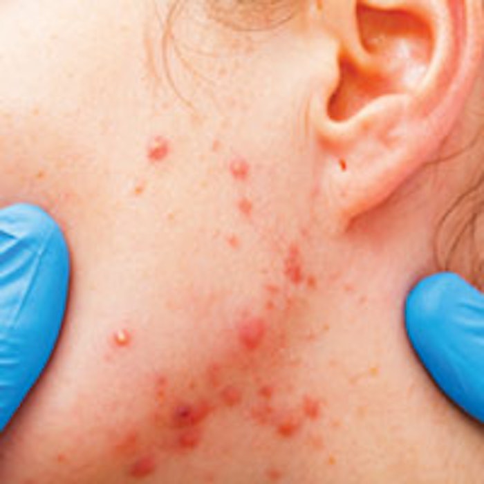 SI1412_SensitiveSkin_acne_m