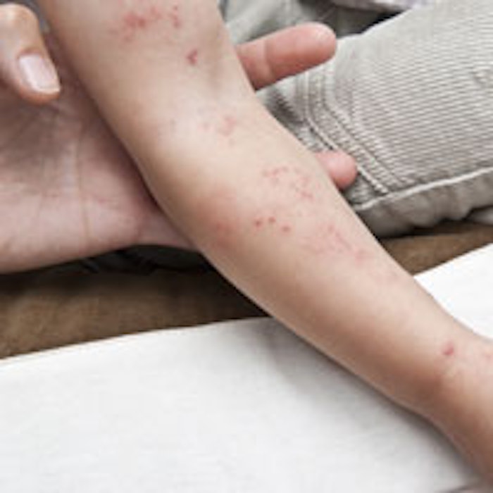 eczema_m2