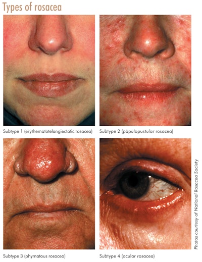 Si1407 Redness Price Fcx