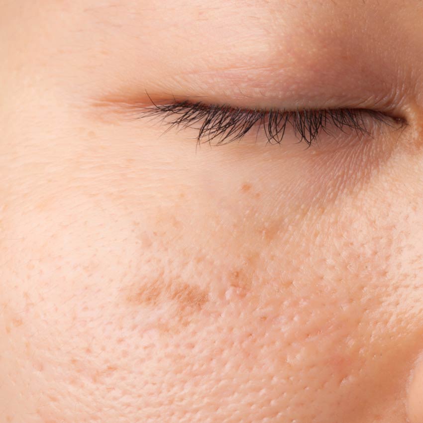 Spot Check: Uncovering Hyperpigmentation to Treat Clients Safely and