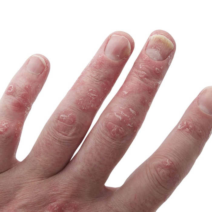 psoriasis_b1