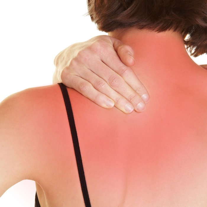 sunburn_b