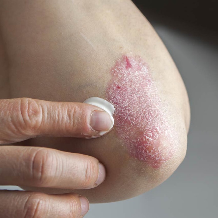 SI1506_News_PsoriasisElbow_850